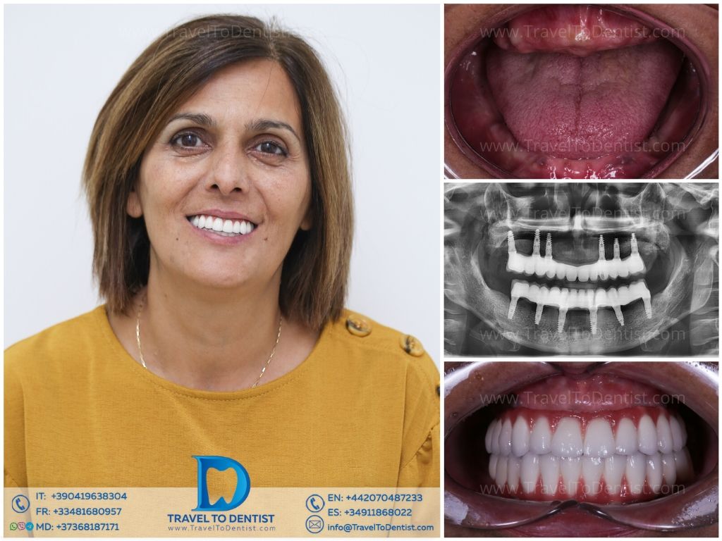 Caso clínico 5 — sonrisa transformada con tratamiento de ortodoncia en Dental Román