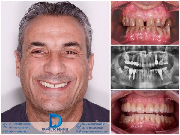 Caso clínico 2 — resultado de ortodoncia y restauración dental en Dental Román